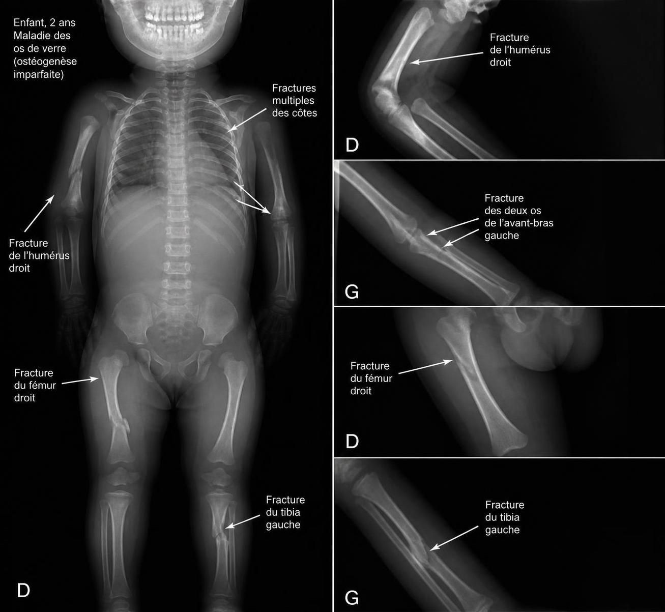 découvrez les causes, symptômes et traitements de la maladie des os de verre, une affection rare affectant la solidité des os, pour mieux comprendre et agir.