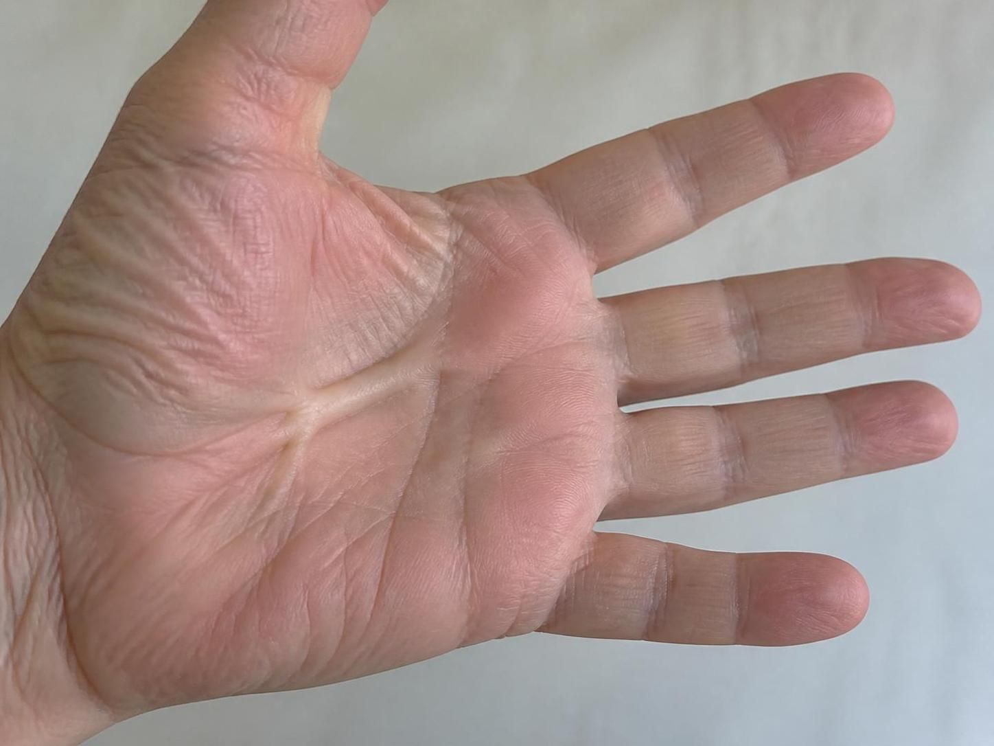 découvrez tout sur la maladie de dupuytren : comprenez ses causes, identifiez les symptômes et explorez les options de traitements disponibles pour mieux gérer cette affection.