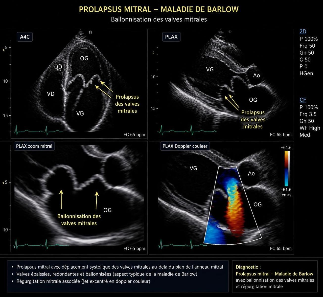 découvrez la maladie de barlow, une cause fréquente de prolapsus mitral, ses symptômes, diagnostic et traitements pour mieux comprendre cette affection cardiaque.