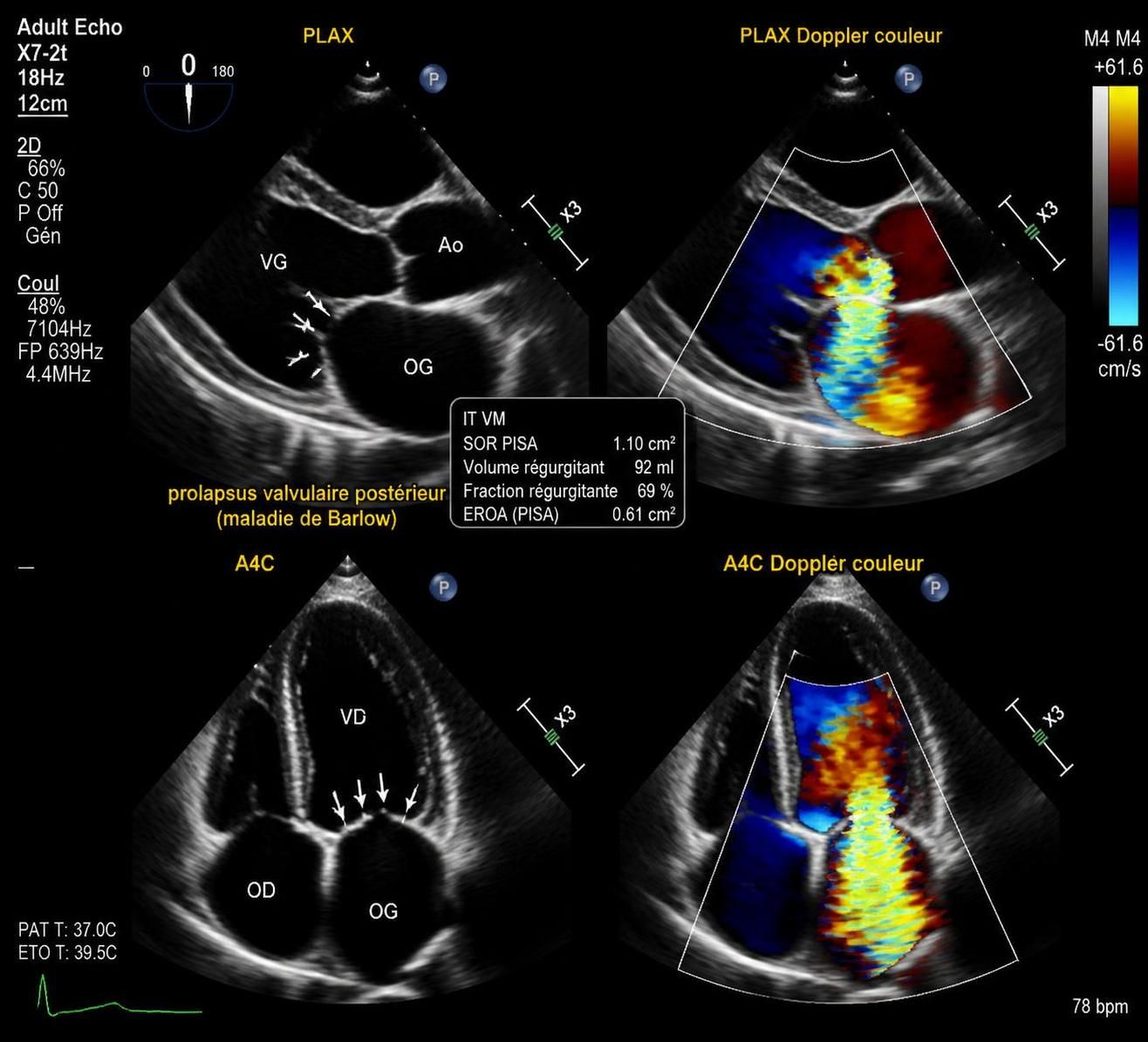 découvrez la maladie de barlow, une cause fréquente de prolapsus mitral, et comprenez ses symptômes, son diagnostic et les options de traitement disponibles.
